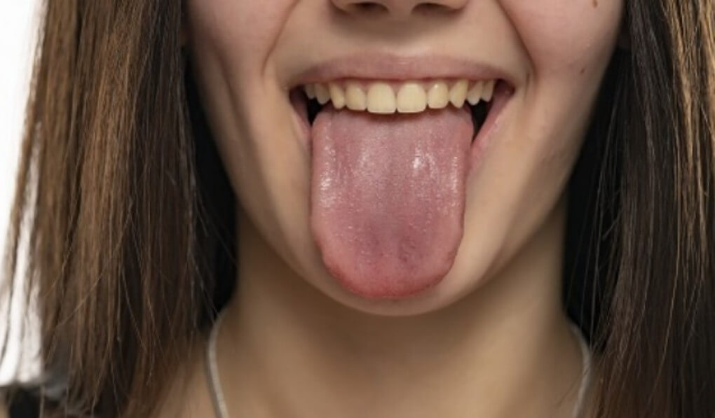 혀끝-통증